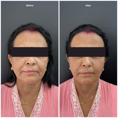 Botox result KOQ10
